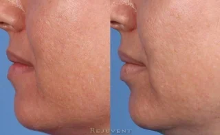 Dermaplaning and Rejuvapen before and after