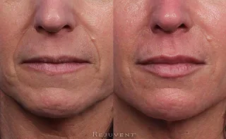 Lip Filler and Amazing Lower Face Rejuvenation
