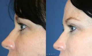 Upper Bleph Eyelid Surgery Side View