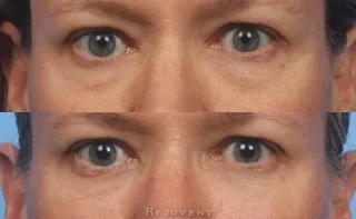Beautiful before after under eye filler injection