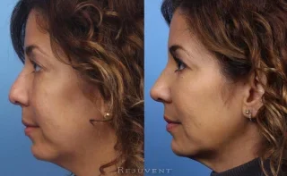 ThermiTight and Non-Surgical Nose Sculpting