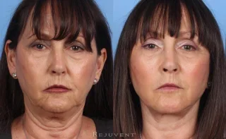 Neck and Face Lift Patient 2