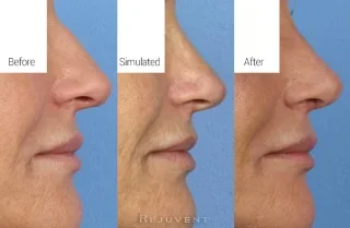 Simulated results versus final rhinoplasty