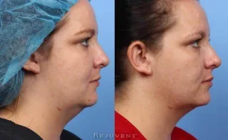 Thermi Tight neck and jawline results