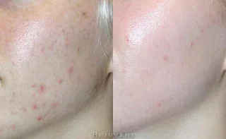 Acne Before After patient 1