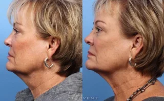 Thermi Tight Jawline and Neck fat