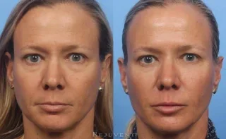 Refreshed and youthful Liquid Facelift Results Front