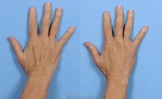 Hand filler beautiful results
