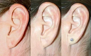 Stretched Earlobe Repair Before and After 