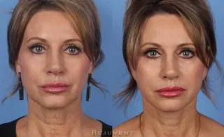 Facelift in Scottsdale with volumizing fillers around moth and lips