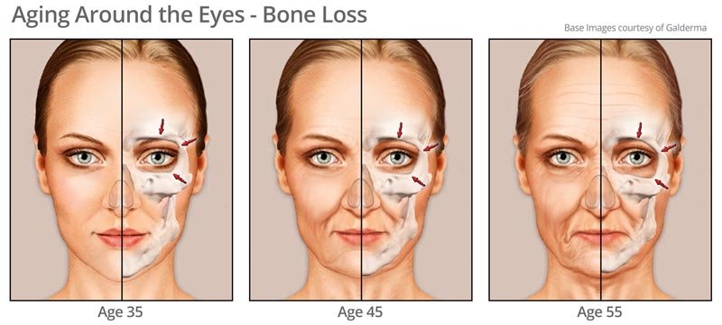 Bone Changes around eye area