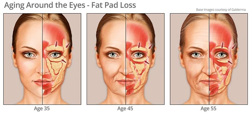 Fat pad changes aging around eye area - under eye fillers can help!