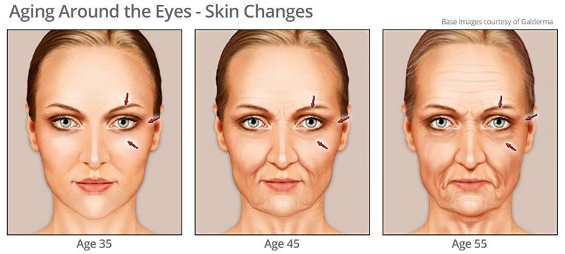 Aging skin around eye area
