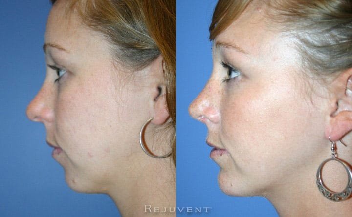 Surgical Chin Augmentation