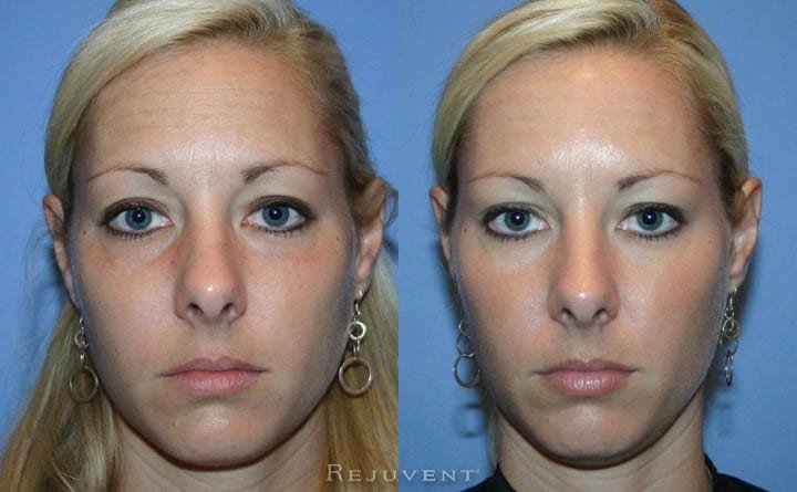 Botox removed this patient's tired look