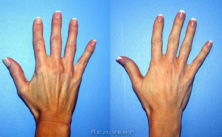 Hand Rejuvenation with dermal fillers