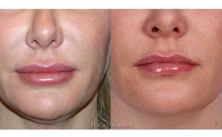 Lip Filler Correction with
