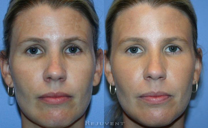 Pigmentation improvement before and after image