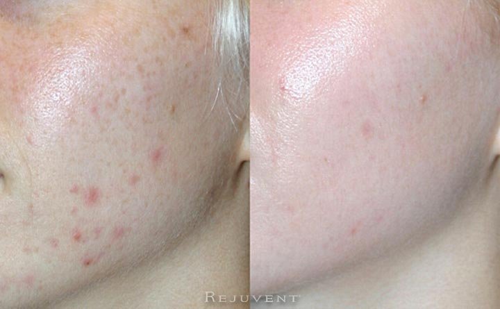 Acne scars before and after