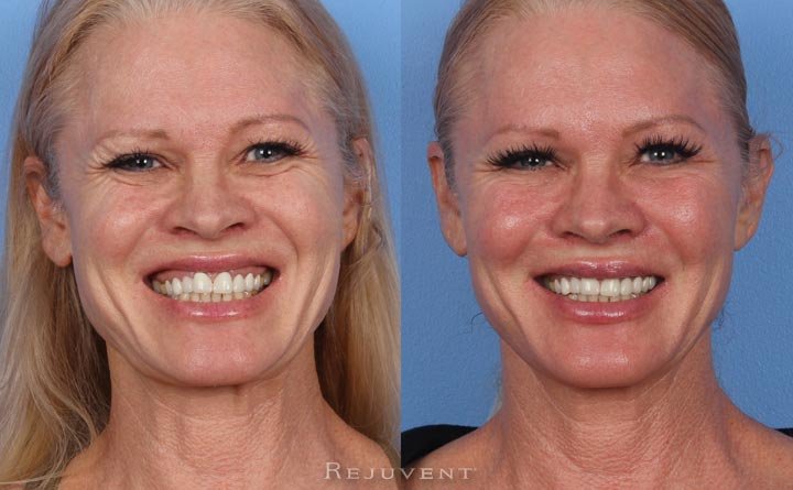 Gummy smile fixed with Botox at Rejuvent Scottsdale