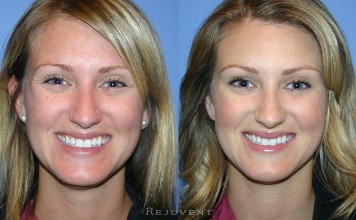 Wrinkle relaxers photo Smiling Botox Patient