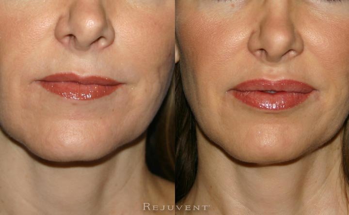Lips with Restylane, Juvederm