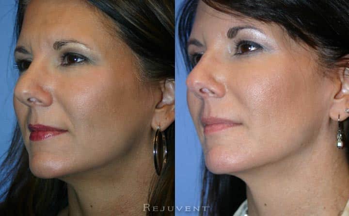 Lower face rejuvenation with fillers