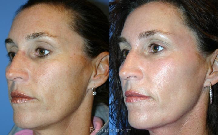 Aging Skin before and after