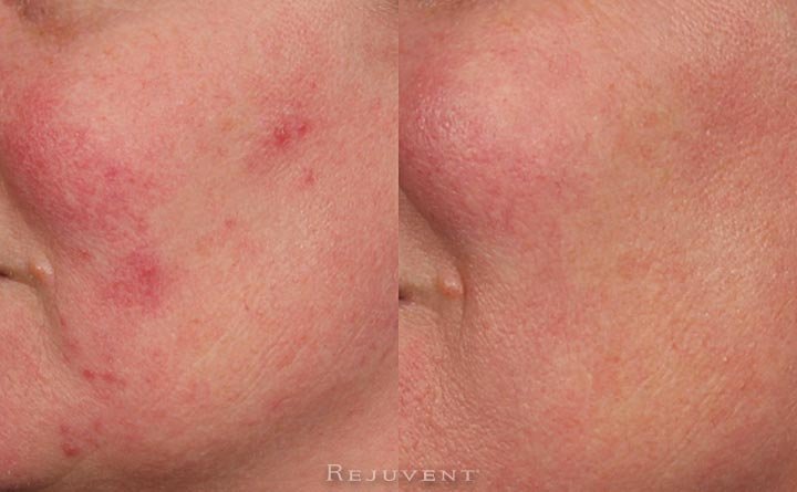 Rosacea and Redness Reduction