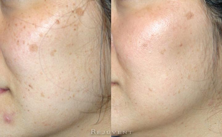 Skin Texture improvement