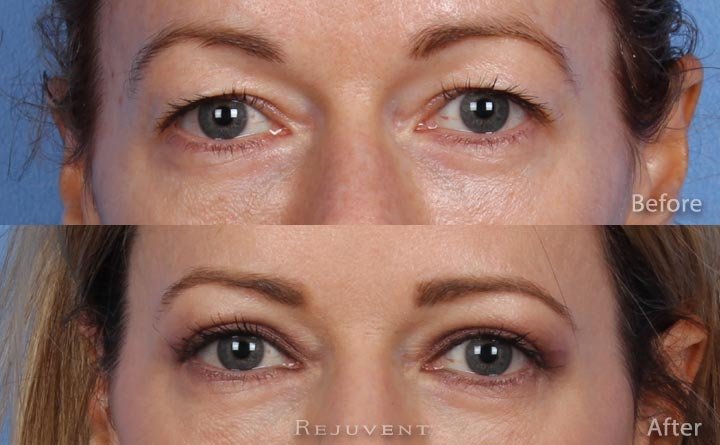 Upper Bleph Eyelid surgery Eyes view