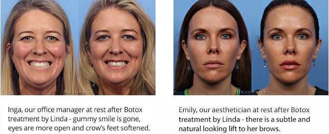 Botox with Linda savings