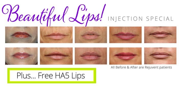 Free HA5 Lips with Lip Volumizing