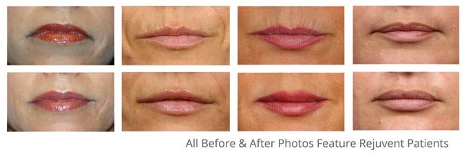 Lip Enhancement with Dr. Bouzoukis