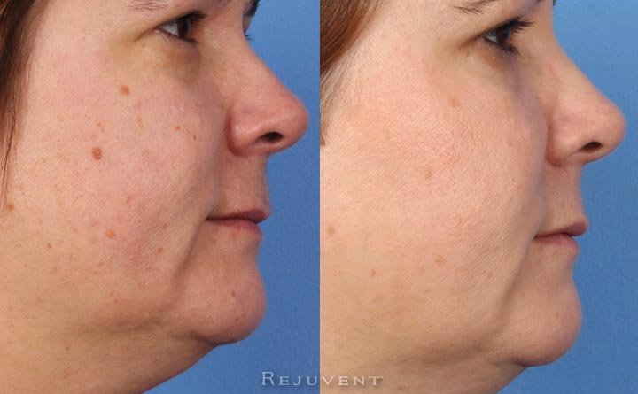 Fotofacial and aesthetic skin treatment results