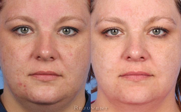 Amazing chemical peel results