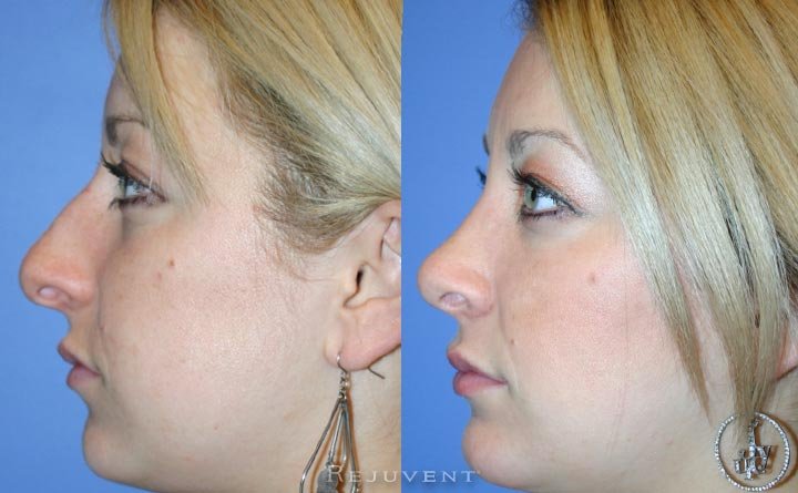 Before after hump rhinoplasty removal