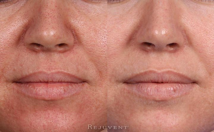 Rejuvapen microneedling before and after