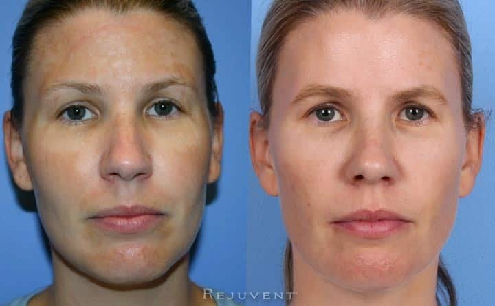 30s skin improvement with skin care and skin treatments