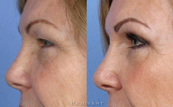 Closeup results Upper eyelid surgery