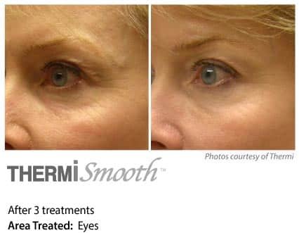 Eyes treated with Thermi Smooth