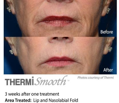Thermi smooth Lips and nasolabial fold