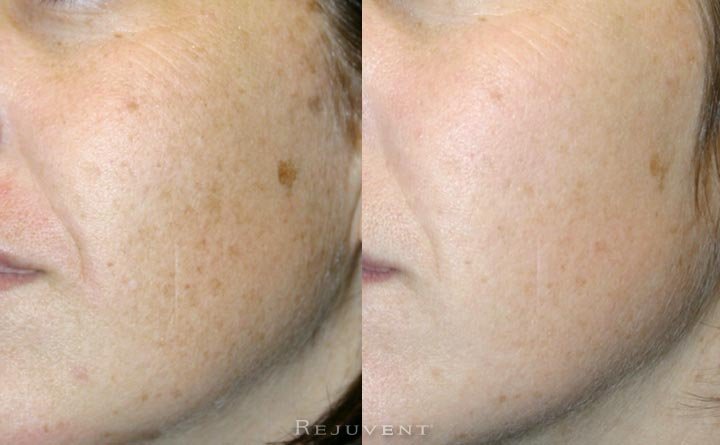 Less hyperpigmentation after skin treatment