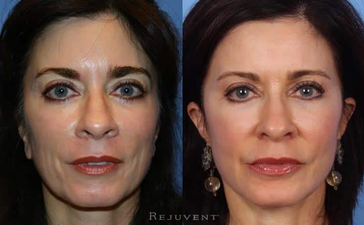 Liquid facelift on aging skin