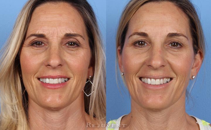 Less wrinkles with Botox