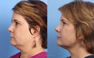 Thermitight neck reduction results