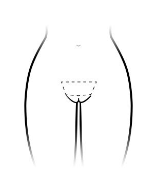 Mons Pubis area for ThermiVa Shaving