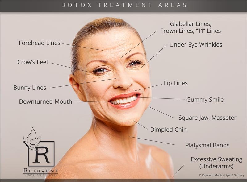 Areas injected with Botox at Rejuvent