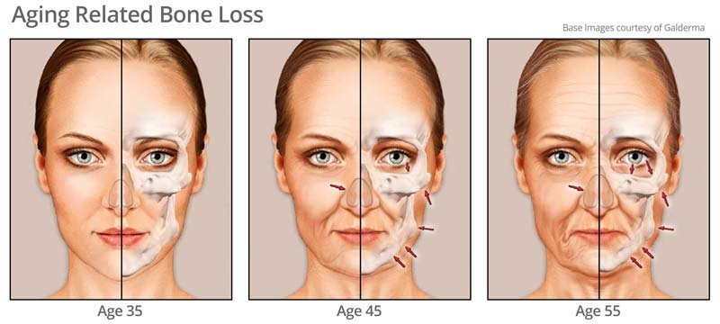 Age related bone loss as you age