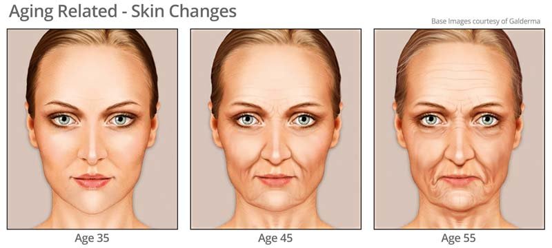 Aging related skin changes